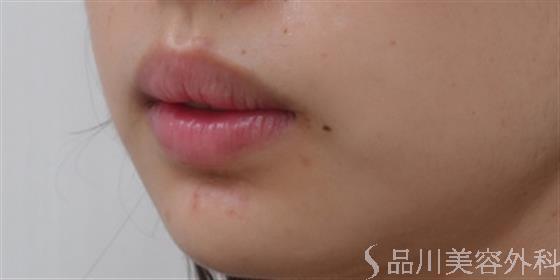 たらこ唇を治す方法は 厚い唇の原因と薄く小さくする方法 医師監修 Shinagawa Beauty Navi