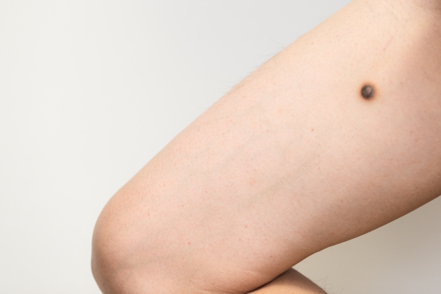 足にできたほくろ