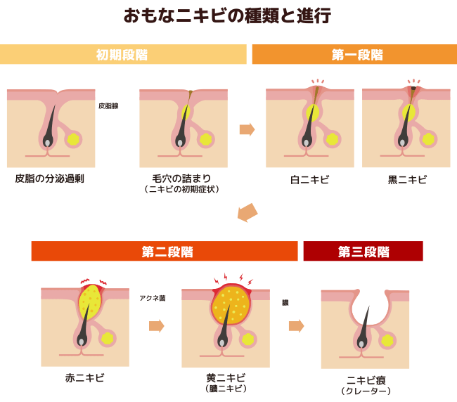おもなニキビの種類と進行 初期段階：皮脂の分泌過剰、毛穴の詰まり（ニキビの初期症状）第一段階：白ニキビ、黒ニキビ 第二段階：赤ニキビ、黄ニキビ、第三段階：ニキビ痕（クレーター）