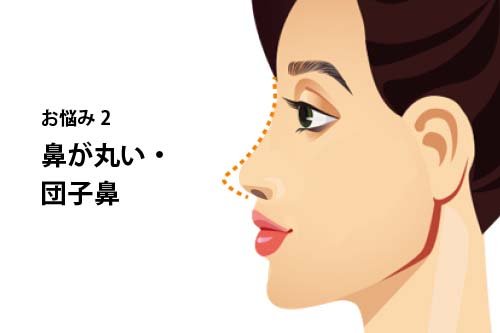 【お悩み別！鼻の整形治療】よくあるお悩み2：鼻が丸い・団子鼻