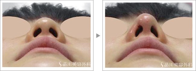 鼻の整形は切るだけじゃない あなたの悩みから選ぶ鼻の治療7つ Shinagawa Beauty Navi