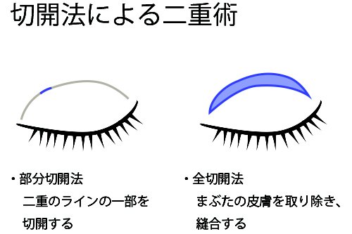 二重にする＝メスで切る…だけじゃない！切る施術はこの２種類