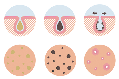 毛穴の詰まり 黒ずみ 開きの正しいケア方法とは Shinagawa Beauty Navi