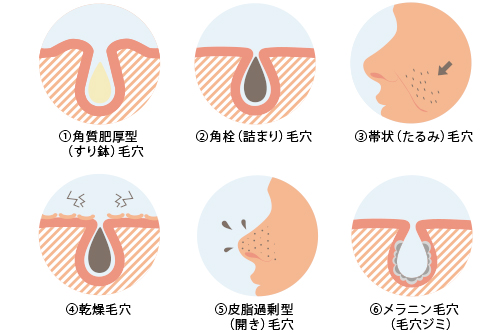 気になる毛穴の種類とその対策 医師監修 Shinagawa Beauty Navi