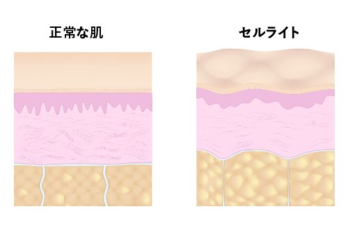 セルライトの形成過程1