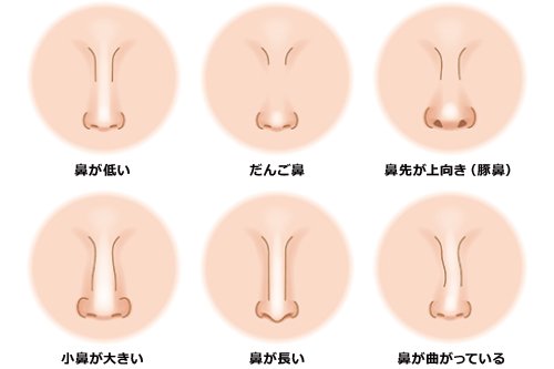 鼻プチvs 鼻の整形 鼻プチの効果や鼻プチとは 医師監修