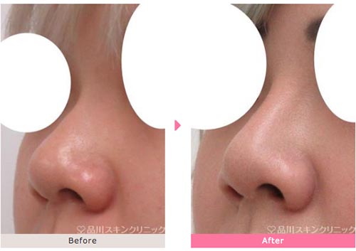 鼻プチvs 鼻の整形 鼻プチの効果や鼻プチとは 医師監修