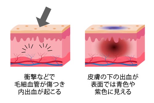 内出血の仕組みは 早く治す方法はあるの