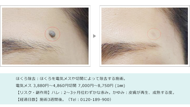 気付いたら増えている ほくろのできる原因と治療方法