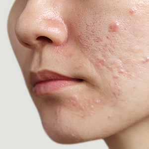 渋谷院のニキビ跡治療