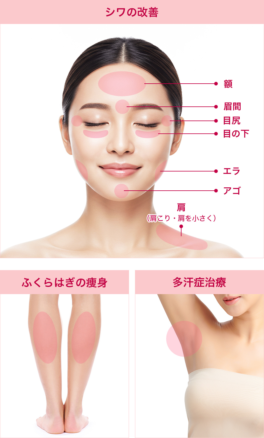 額 眉間 目尻 目の下 エラ アゴ 肩（肩こり・肩を小さく） ふくらはぎの痩身 多汗症治療