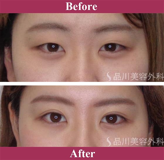 二重術ナチュラル法 症例写真【画像】