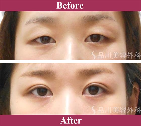 二重術ナチュラル法 症例写真【画像】