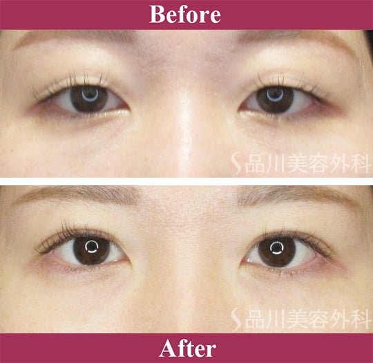 二重術エバーナチュラル法（埋没法）症例写真【画像】