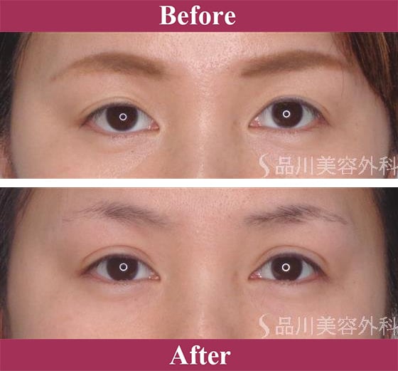 二重術エバーナチュラル法（埋没法）症例写真【画像】