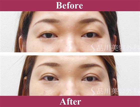 二重術エバーナチュラル法（埋没法）症例写真【画像】