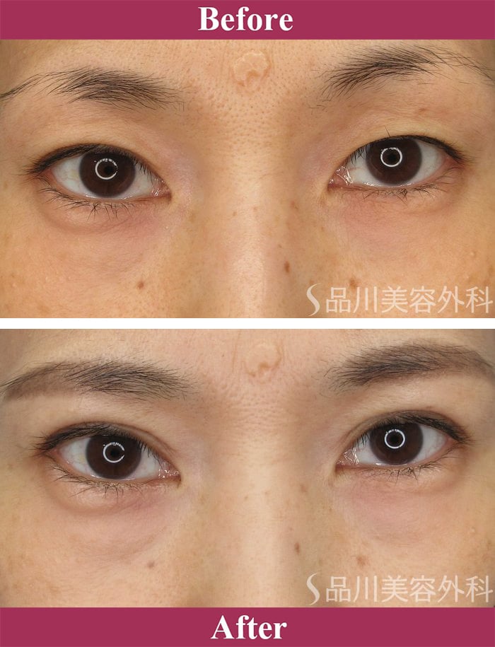 二重術切開法 症例写真【画像】