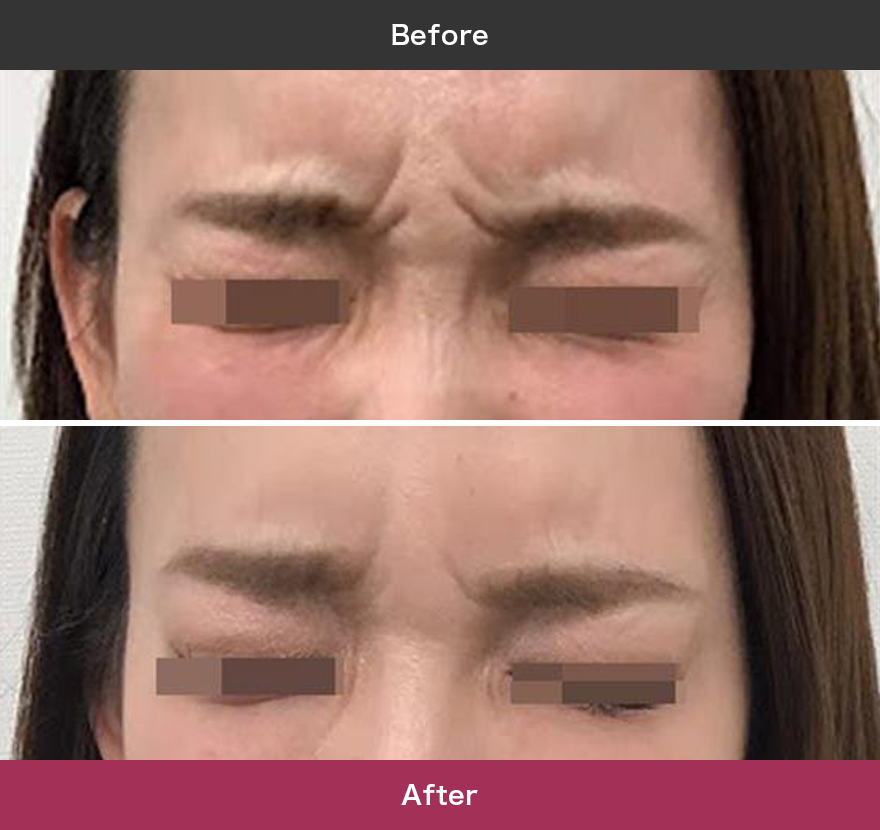 アラガン社ボトックス注射 症例写真【画像】
