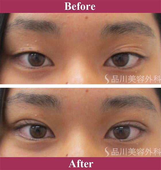 二重術エバーナチュラル法（埋没法）症例写真【画像】