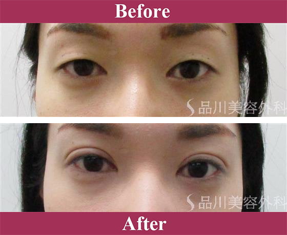 二重術エバーナチュラル法（埋没法）症例写真【画像】