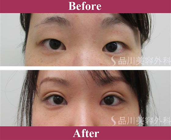 二重術エバーナチュラル法（埋没法）症例写真【画像】