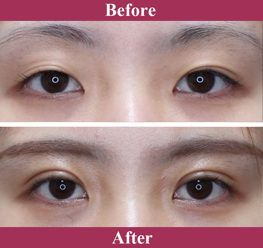 二重術エバーナチュラル法（埋没法）症例写真【画像】