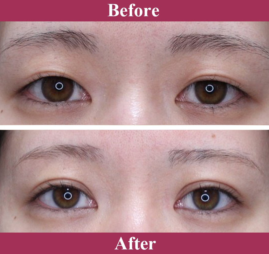 二重術エバーナチュラル法（埋没法）症例写真【画像】