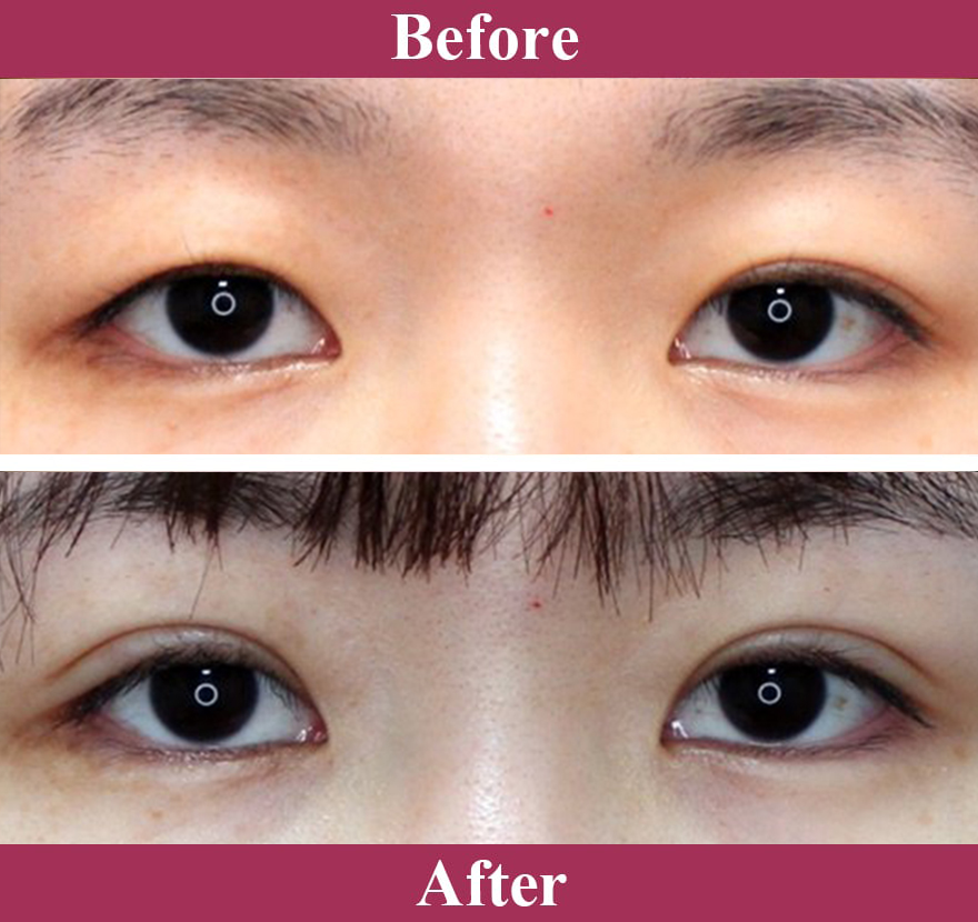 二重術エバーナチュラル法（埋没法）症例写真【画像】