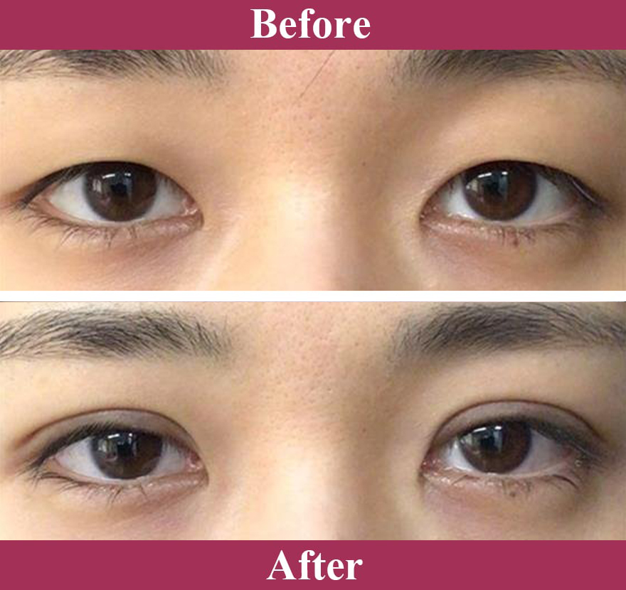 二重術エバーナチュラル法（埋没法）症例写真【画像】