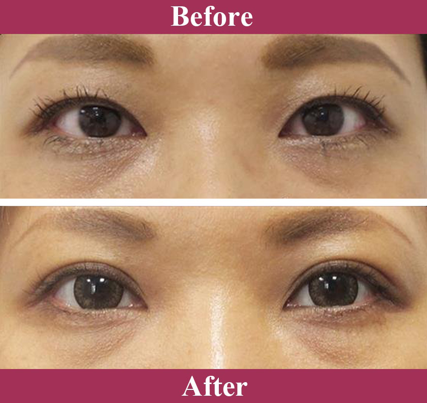 二重術ナチュラル法 症例写真【画像】