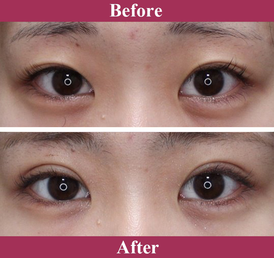 二重術ナチュラル法 症例写真【画像】