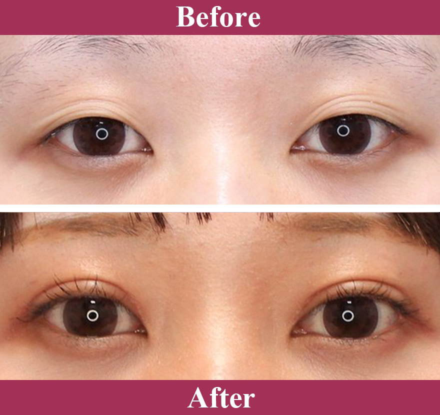 二重術切開法 症例写真【画像】