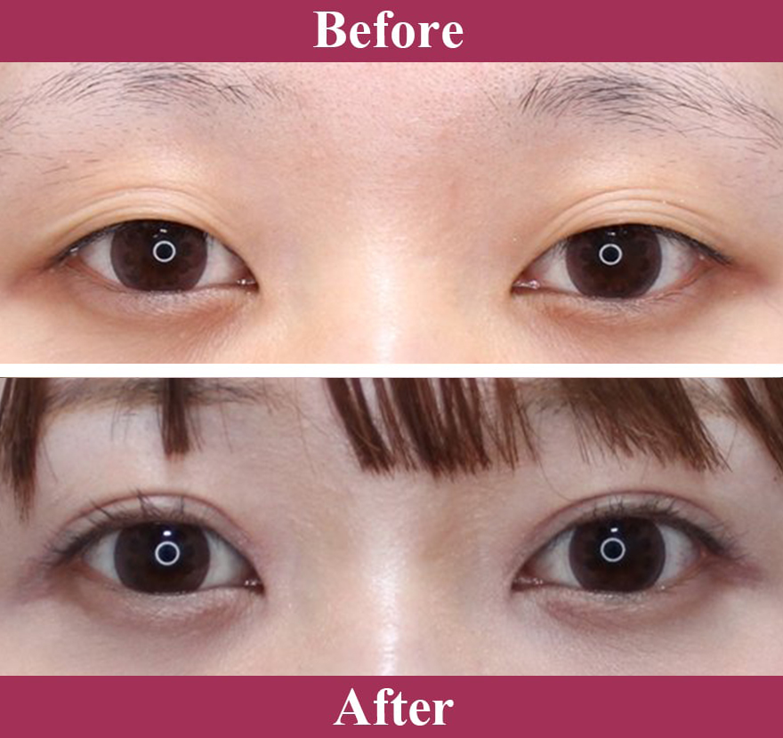 二重術切開法 症例写真【画像】