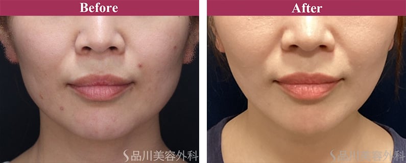 美肌糸リフト 症例写真【画像】
