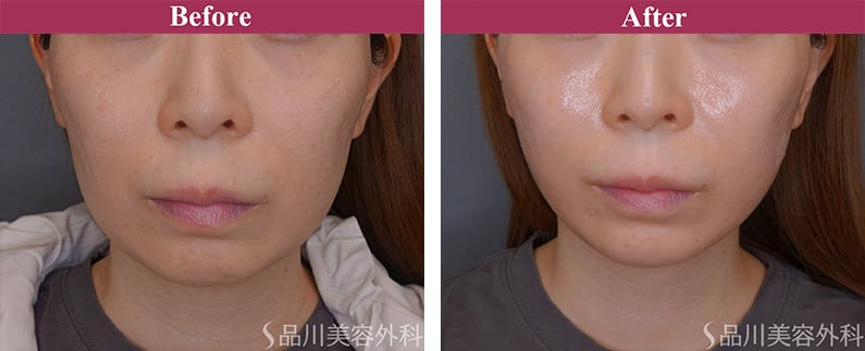 美肌糸リフト 症例写真【画像】