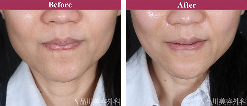 美肌糸リフト 症例写真【画像】