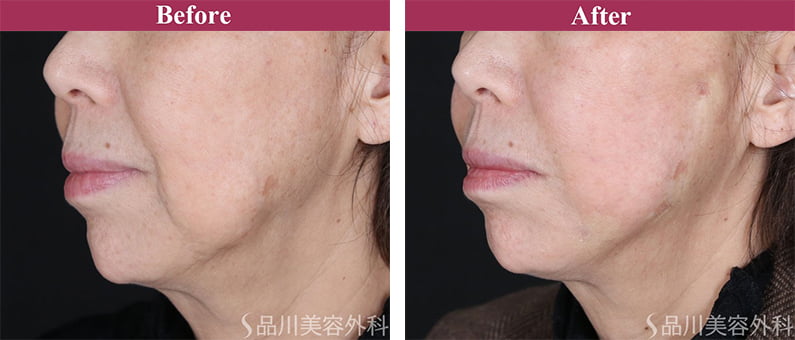 美肌糸リフト 症例写真【画像】