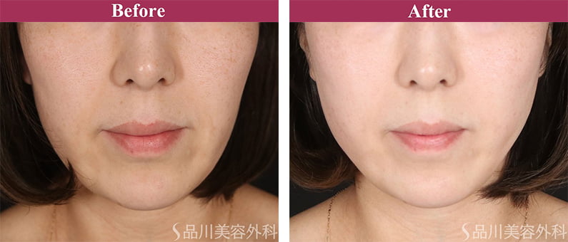 美肌糸リフト 症例写真【画像】