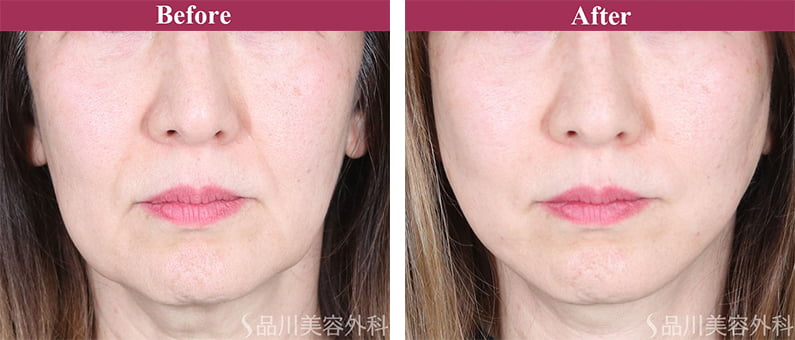 美肌糸リフト 症例写真【画像】