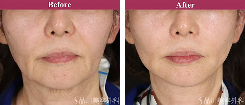 美肌糸リフト 症例写真【画像】