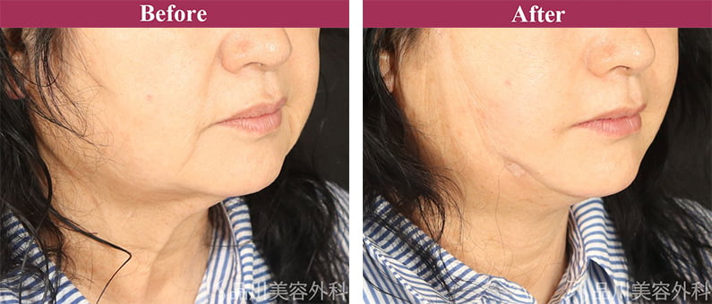 美肌糸リフト 症例写真【画像】