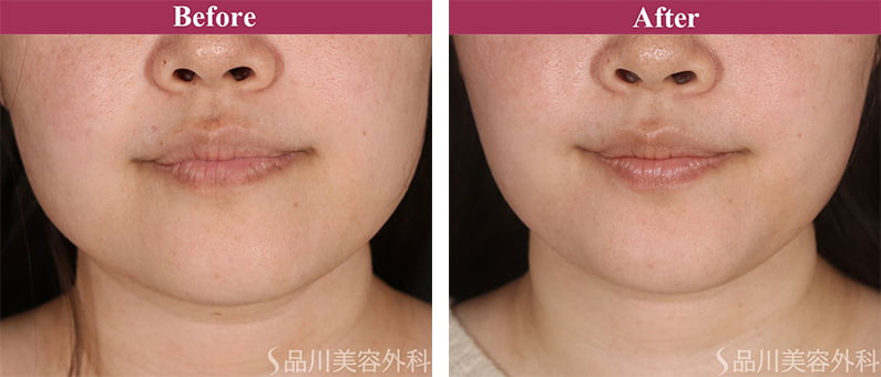 美肌糸リフト 症例写真【画像】