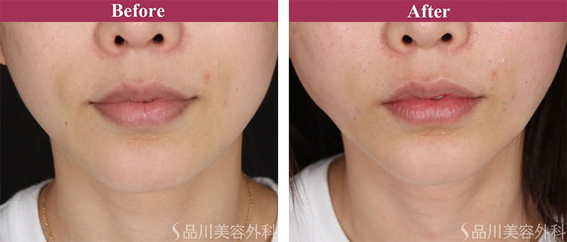 美肌糸リフト 症例写真【画像】