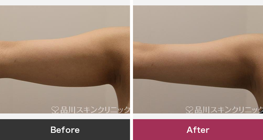 クールスカルプティング&reg; 症例写真【画像】