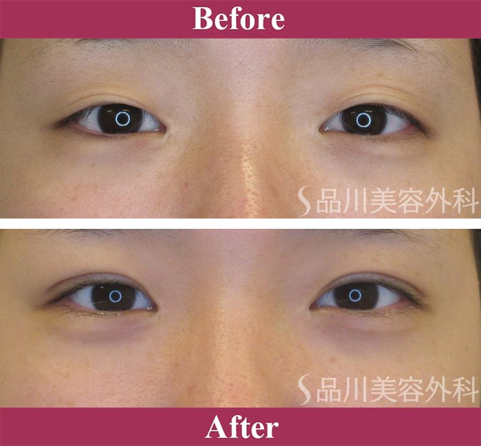 二重術エバーナチュラル法（埋没法）症例写真【画像】