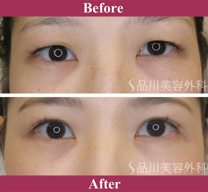 二重術エバーナチュラル法（埋没法）症例写真【画像】