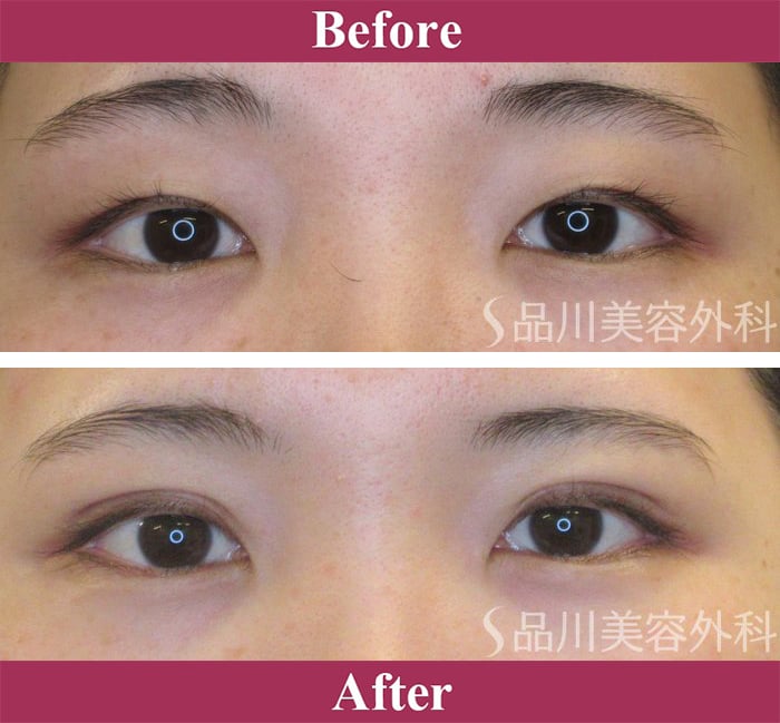 二重術エバーナチュラル法（埋没法）症例写真【画像】