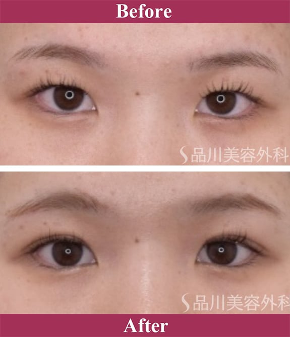 二重術エバーナチュラル法（埋没法）症例写真【画像】