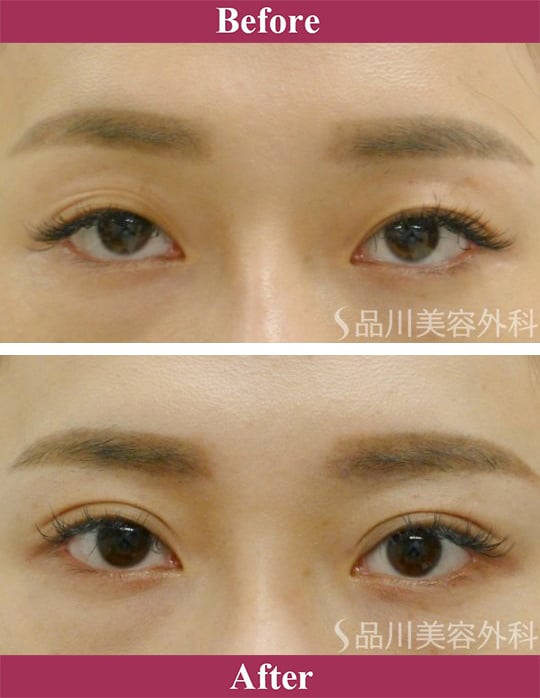 二重術エバーナチュラル法 症例写真【画像】