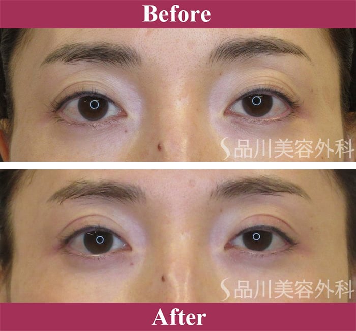 二重術ナチュラル法 症例写真【画像】
